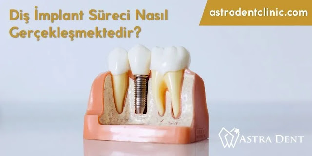Diş İmplantı Yapım Aşamaları