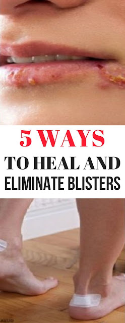 5 WAYS TO HEAL AND ELIMINATE BLISTERS!