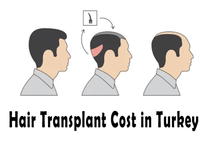 Hair Transplant Cost in Turkey by City with Best Clinics