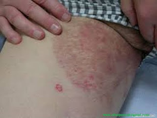 Obat Eksim Kering Tahunan, Gambar Penyakit Eksim Di Wajah, Obat gatal eksim Basah Pada Bayi, Eksim Atau Psoriasis, Obat gatal eksim Kering Alami, Mengobati Eksim Dengan Kunyit, gatal eksim Kering Penyebab, contoh gatal eksim, Jamu Eksim Cobra, Mengobati Eksim Dengan Madu, obat gatal eksim menahun, Obat Gatal Di Kemaluan Cowok, Penyakit Kulit gatal eksim Numular, Obat Salep gatal eksim Basah Di Apotik, Ramuan Tradisional Penyakit Kulit gatal eksim, Ciri2 Penyakit gatal eksim Kering, Eksim Kering Pada Lutut, Cara Mengobati gatal eksim Kering Pada Wajah, Eksim Menular Gak, Obat Alami Penyakit Eksim Kering, gatal eksim Di Daun Telinga, Salep Eksim Basah Yang Manjur, Cara Alami Mengobati Eksim Menahun, Obat Eksim Pada Jari Kaki, Ramuan Mengobati gatal eksim, Obat Herbal gatal eksim Terbukti Keampuhannya, Berapa Lama Penyakit Eksim Sembuh, Obat Penyakit Kulit Eksim Secara Alami, Ciri Eksim Basah, Eksim Wiki, Obat Eksim Kulit Paling Ampuh, Obat Dokter Untuk Penyakit gatal eksim, Obat Manjur Untuk Eksim Kering, Apa Itu gatal eksim Dan Dermatitis, Cara Mengobati Eksim Dengan Lengkuas 