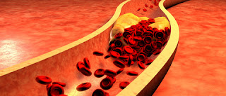 high blood pressure, arteriosclerosis, plaque, hypertension, prehypertension