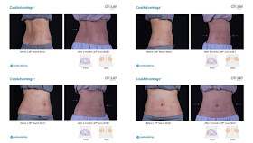 CoolSculpting Treatment, Clique Clinic, CoolSculpting Review, Slimming, Beauty 