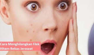 cara menghilangkan flek hitam bekas jerawat