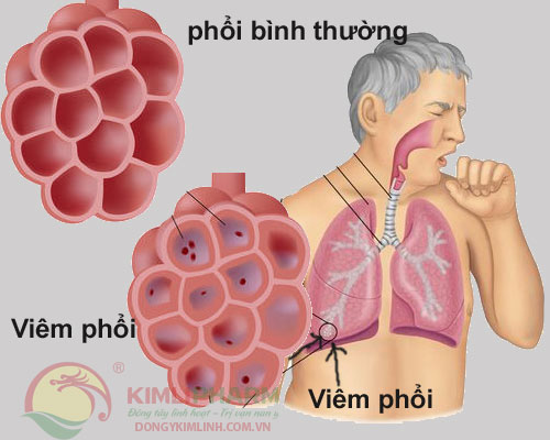 nguyên nhân và triệu chứng viêm phổi