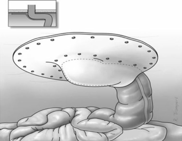 Laparoscopic Sugarbaker Technique