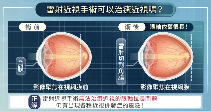 雷射近視手術可以治癒眼睛嗎