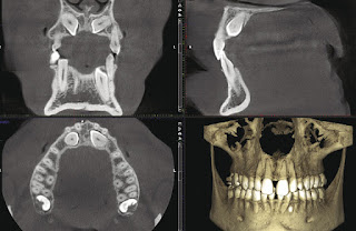 Dental-CAD Cam