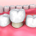 Tìm hiểu về kỹ thuật bọc răng sứ