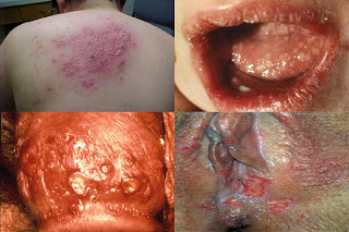 Obat Sipilis Di Malaysia