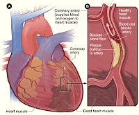 askep penyakit jantung koroner, asuhan keperawatan jantung koroner, penyakit jantung koroner