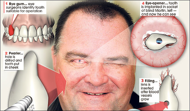 Blind man sees after tooth inserted into eye 