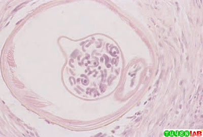 Cross-section of tissue infected with Onchocerca volvulus.