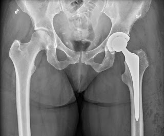 X-ray of the hip of a 51 year old nurse with idiopathic avascular necrosis of the left femoral head. Pre-operative Anteroposterior image of pelvis. Also visible: - IUD with progesterone, justaposed to an extracorporeal object - Selveral pelvic phleboliths - Side markings:    - Dx = dexter = right side of patient    - Sin = sinister = left side - Calibration ball marker Anteroposterior detail, showing cyst-like radiolucencies and irregular surface of the femoral head, indicating avascular necrosis. Lateral Cropped image of normal contralateral hip After hip replacement Anteroposterior image of pelvis Anteroposterior image. Focal postoperative radiolucent emphysematous spots are visible. Lateral image. Surgical staples are projected.