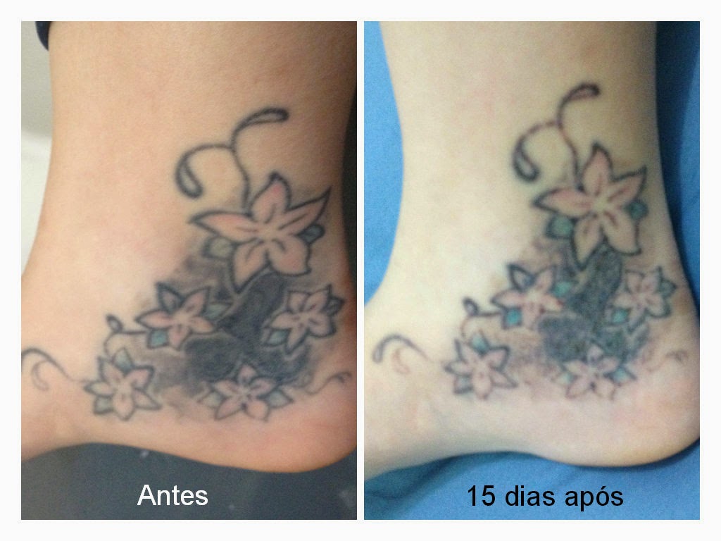 Conheça os mitos e verdades sobre remoção de tatuagem Viver Bem