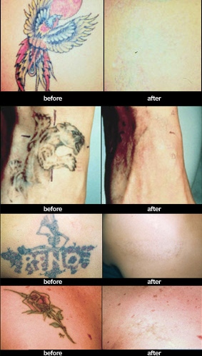 ... Difference: Update: New Tattoo Removal System at Cosmetic Laser MD