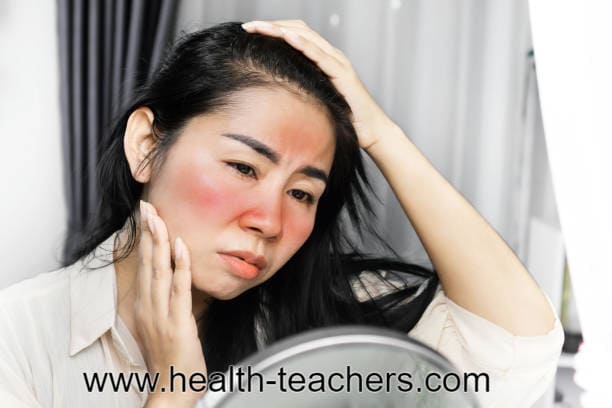 Important measures and prescriptions for prevention of rash diseases - Health-Teachers