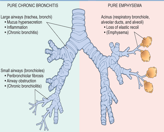 Comparison of Chronic Bronchitis and Emphysema. | Geoffrey ...