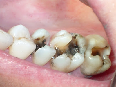 Phân tích răng hàm bị sâu có nên nhổ đi không 1