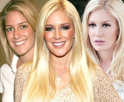 heidi montag before and after plastic surgery interview. ivanka trump plastic surgery