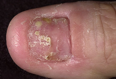 Nail Psoriasis Overview.