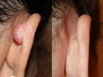 Large keloids can be surgically removed successfully without recurrence.