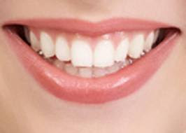 cara agar gigi menjadi putih
