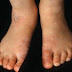 Tips Mengatasi Gatal Kulit di sekitar kulit kaki