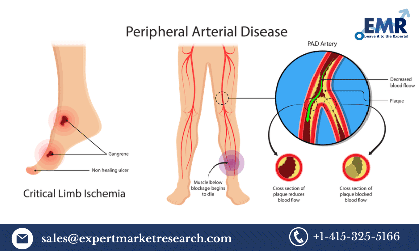 Peripheral Artery Disease Market