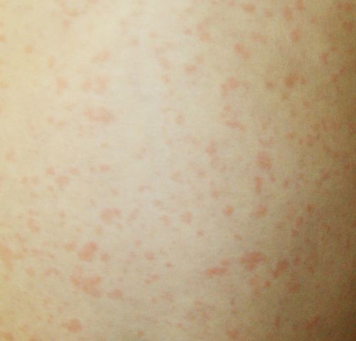 info i have a rash,