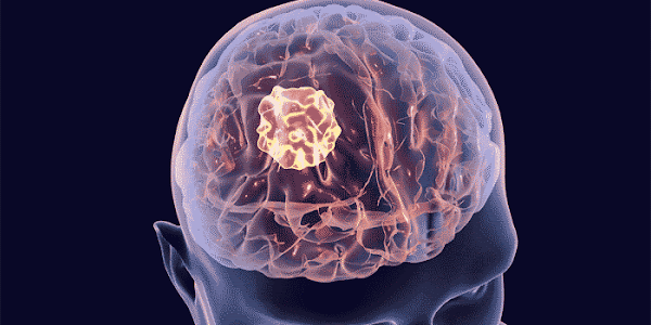 Brain Tumors | ഈ ലക്ഷണങ്ങള്‍ നിങ്ങളില്‍  പ്രകടമാകുന്നുണ്ടോ? എങ്കില്‍ തലച്ചോറില്‍ മുഴകള്‍ ഉണ്ടാകാം