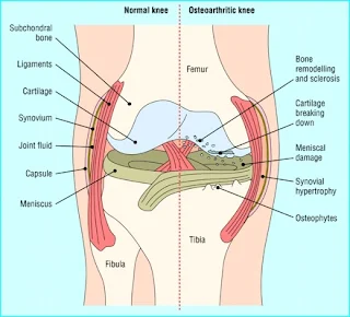 Osteoarthritis