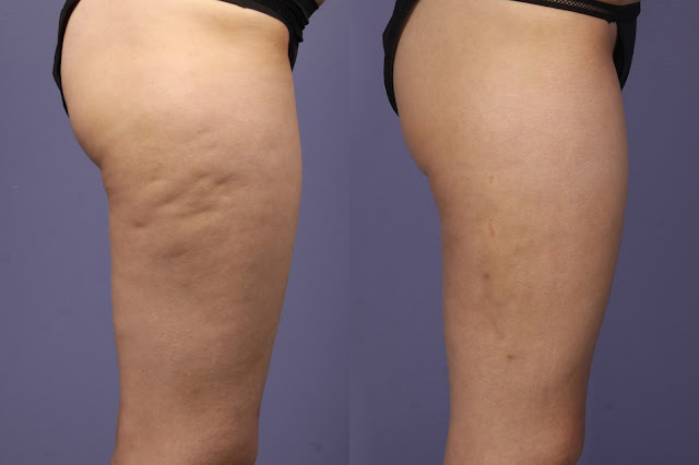 how-to-reduce-cellulite