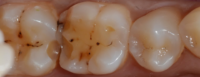 Lost Enamel on Molar Tooth