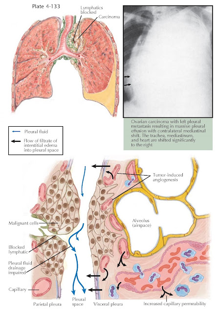 PLEURAL EFFUSION IN MALIGNANCY