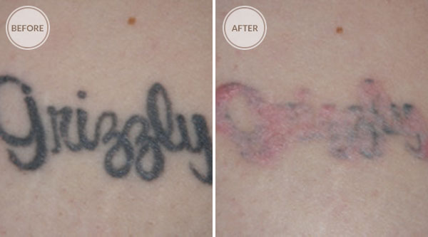 Salabrasion Tattoo Removal At Home – Avie Home