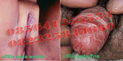 Obat Untuk Sipilis Atau Raja Singa