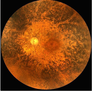 Retinosis Pigmentaria