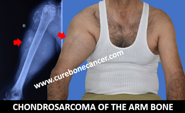 Chondrosarcoma Treatment in India