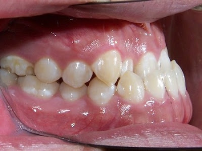 Quy trình niềng răng móm theo tiêu chuẩn