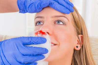 Bersatulah - Cara Menghentikan Pendarahan Hidung atau Mimisan