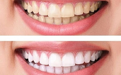 Tẩy trắng răng tại nhà bằng giấm có an toàn? 2