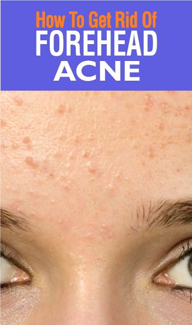 Forehead Acne: Causes, Treatment, And Prevention Tips