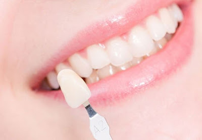 Trồng răng sứ thẩm mỹ áp dụng hiệu quả cho trường hợp nào?-1