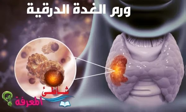 ورم الغدة الدرقيةThyroid tumor