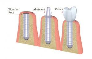 Implant có cấu tạo như thế nào?