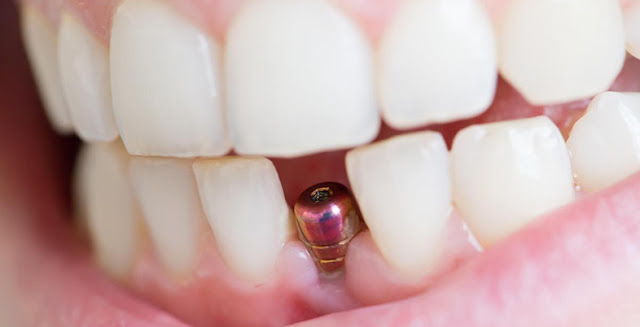 Dental Implants in Mayur Vihar