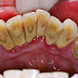 Tình trạng cao răng có màu đen