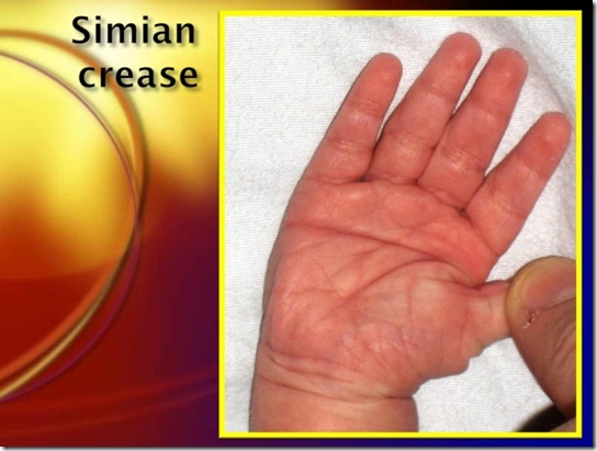 simian crease