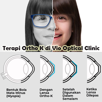 Alasan Memilih Terapi Ortho K di Vio Optical Clinic