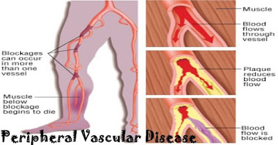 Peripheral Vascular Disease Pictures